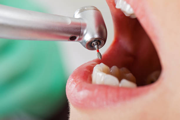 Best Broken or Cracked Tooth Emergency Dentist in Guerneville, CA